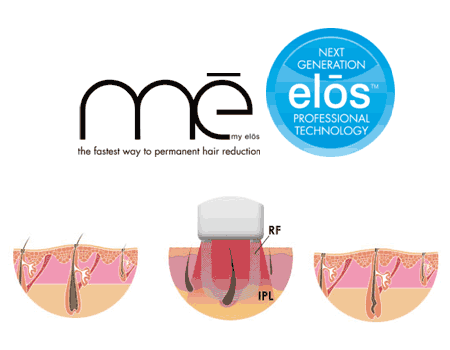 ME MY ELOS SUPREME - 300 000 импулса + приставка епилатор + приставка за прецизно третиране
