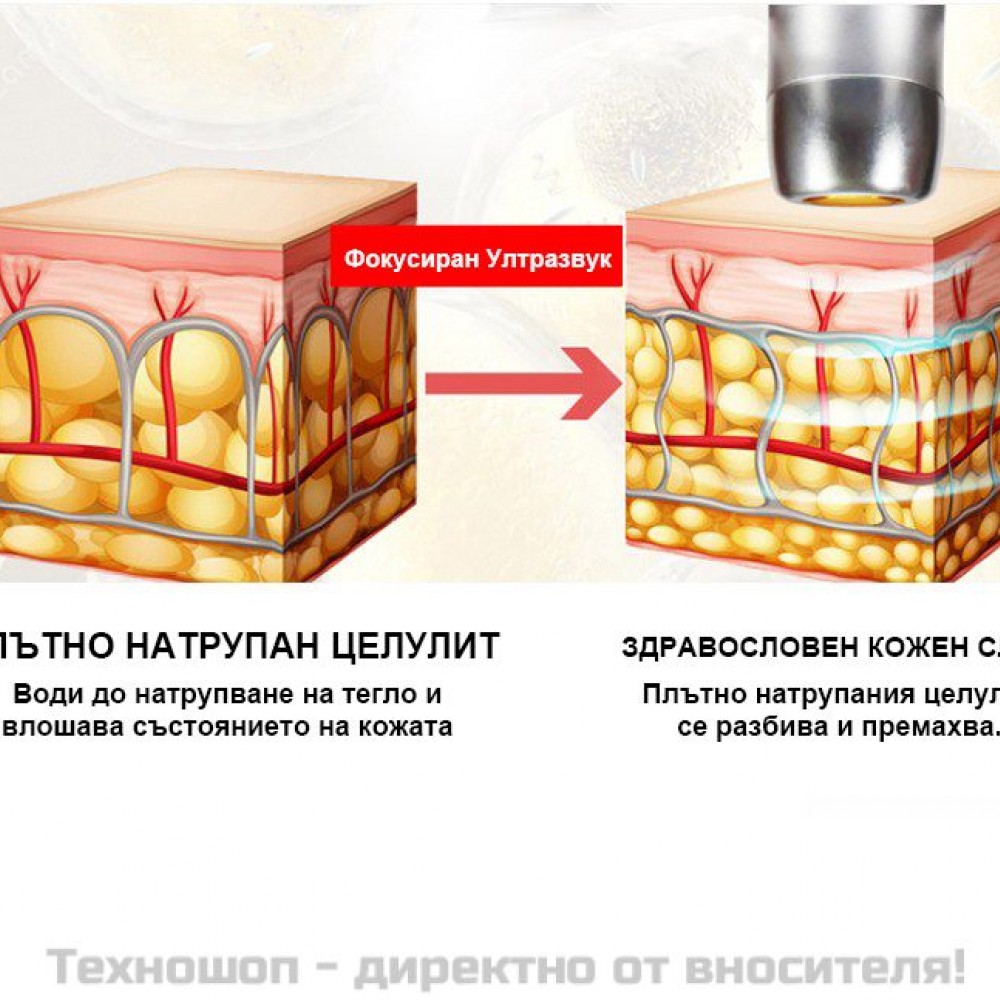 Лифтинг и подмладяване на кожата - Апарат V-Max HIFU