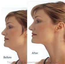 УРЕД ПРОТИВ ДВОЙНА БРАДИЧКА "Neckline Slimmer" – снимка 4