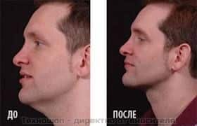 УРЕД ПРОТИВ ДВОЙНА БРАДИЧКА "Neckline Slimmer" – снимка 11