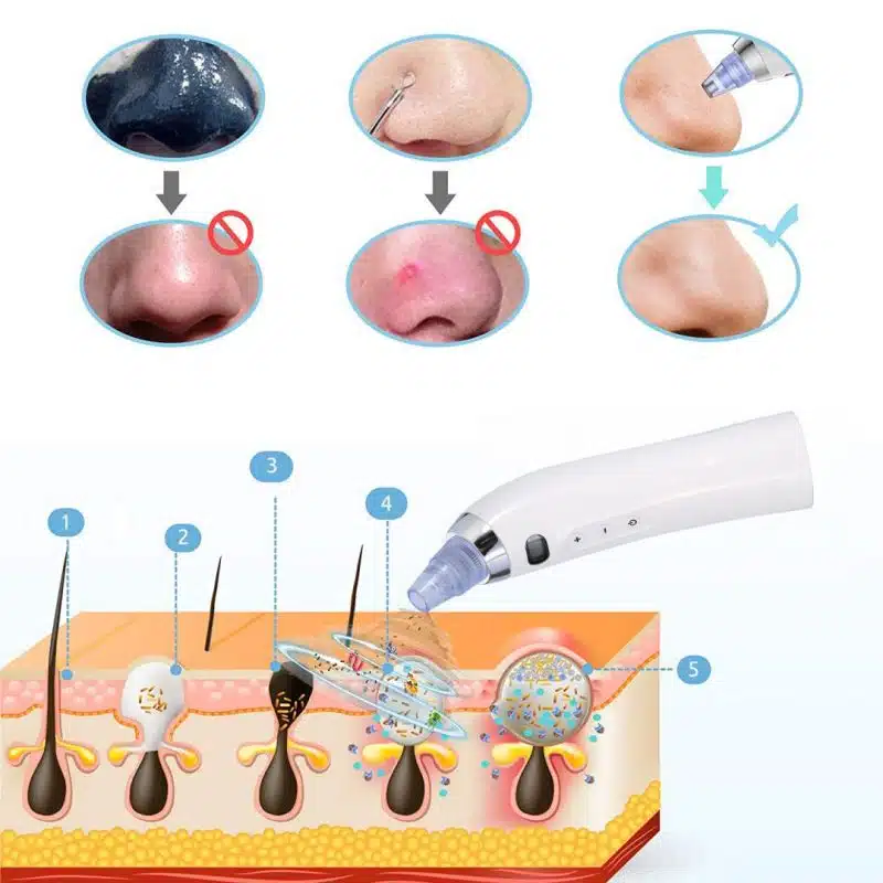 Вакуум уред за почистване на лице и черни точки Вакуум уред за почистване на лице и черни точки