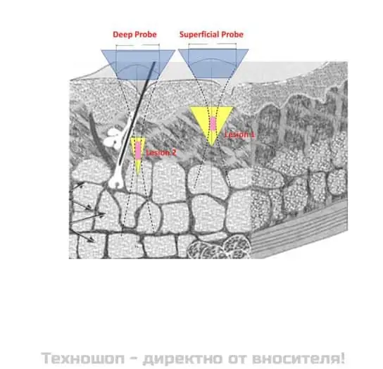 Лифтинг и подмладяване на кожата - Апарат V-Max HIFU